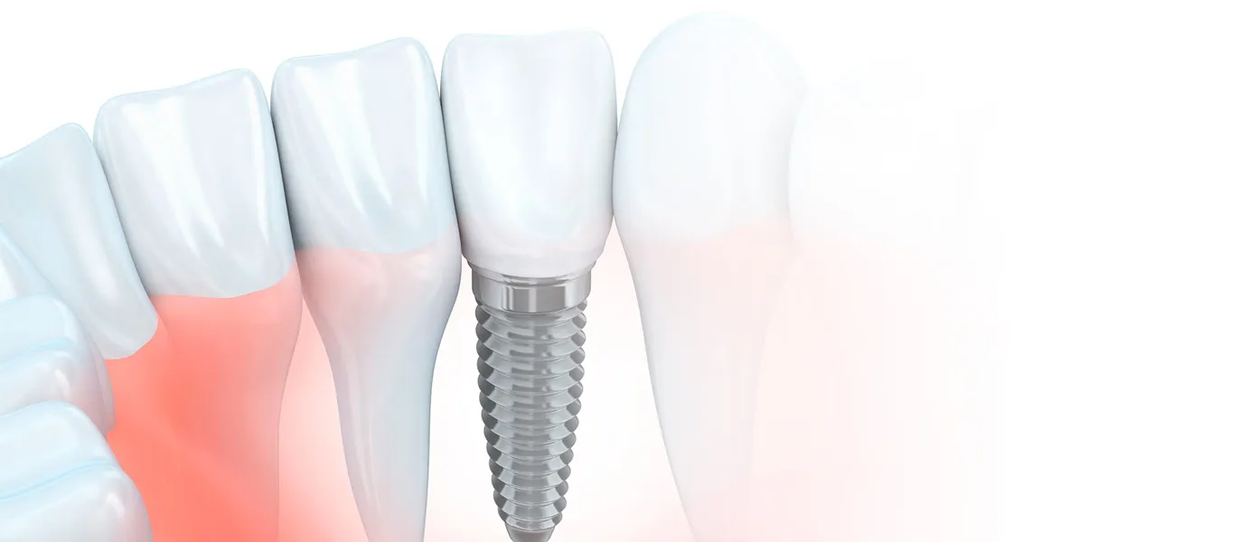 Tratamiento de implantología dental