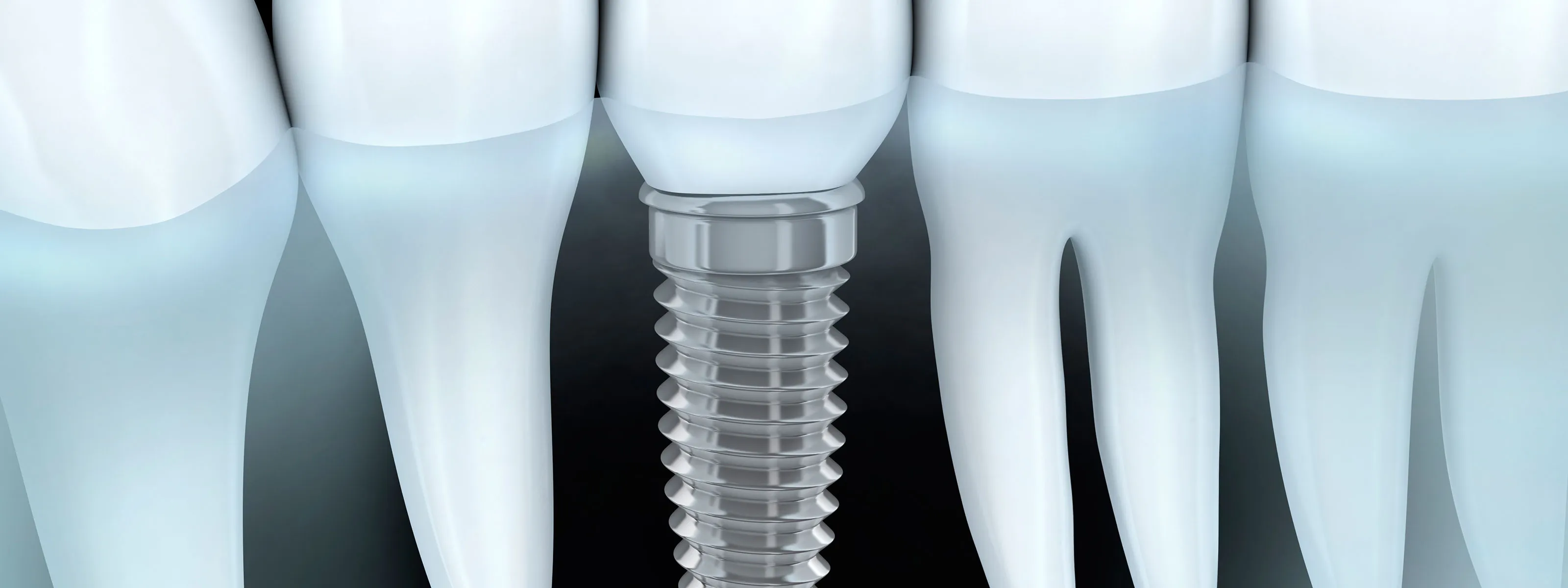 Implante dental de titanio colocado en el hueso